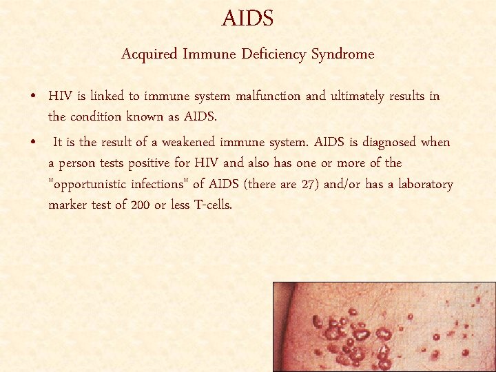 AIDS Acquired Immune Deficiency Syndrome • HIV is linked to immune system malfunction and
