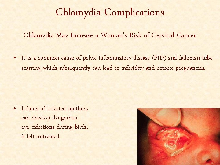 Chlamydia Complications Chlamydia May Increase a Woman's Risk of Cervical Cancer • It is