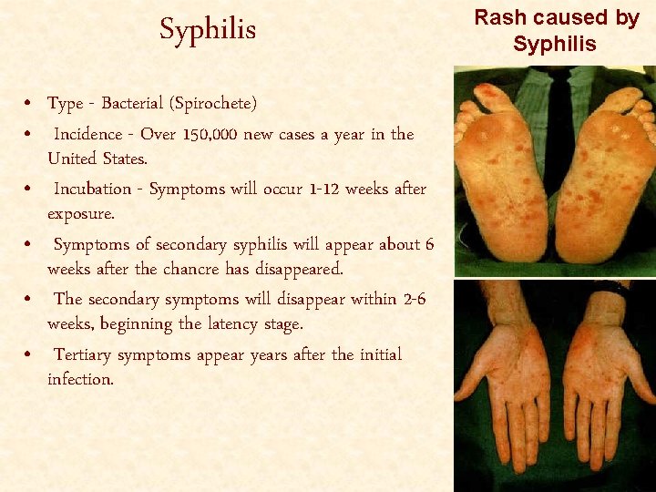 Syphilis • Type - Bacterial (Spirochete) • Incidence - Over 150, 000 new cases