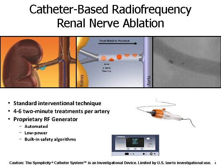 Catheter-Based Radiofrequency Renal Nerve Ablation • Standard interventional technique • 4 -6 two-minute treatments