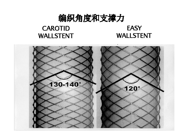 编织角度和支撑力 CAROTID WALLSTENT EASY WALLSTENT 