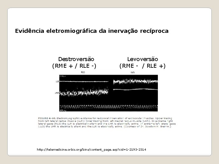 Evidência eletromiográfica da inervação recíproca Destroversão (RME + / RLE -) Levoversão (RME -
