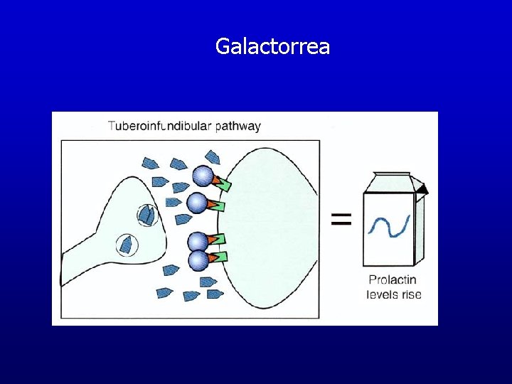 Galactorrea Galactorrea