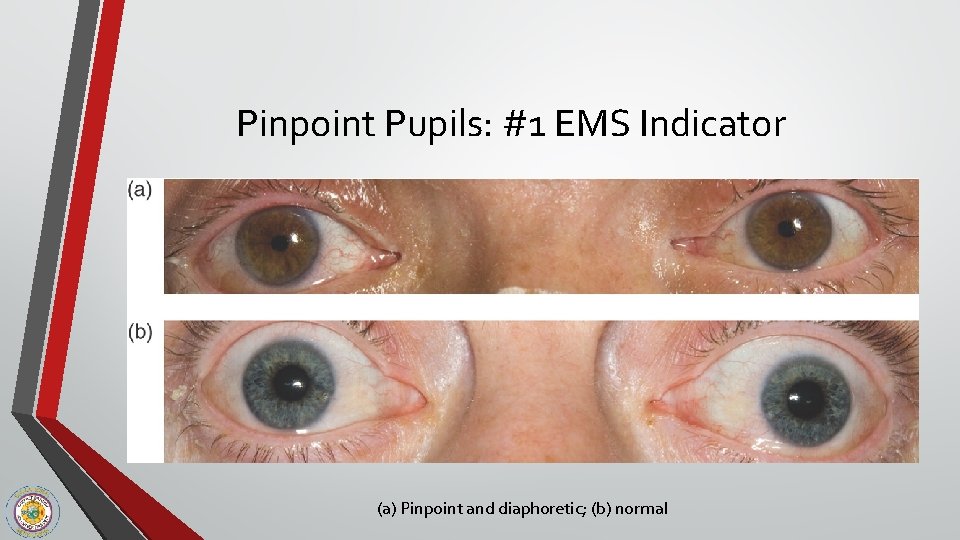 Pinpoint Pupils: #1 EMS Indicator (a) Pinpoint and diaphoretic; (b) normal 