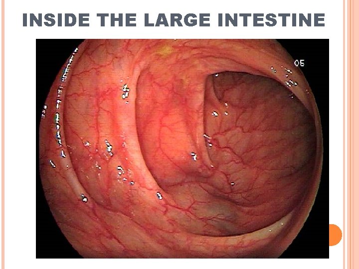 INSIDE THE LARGE INTESTINE 