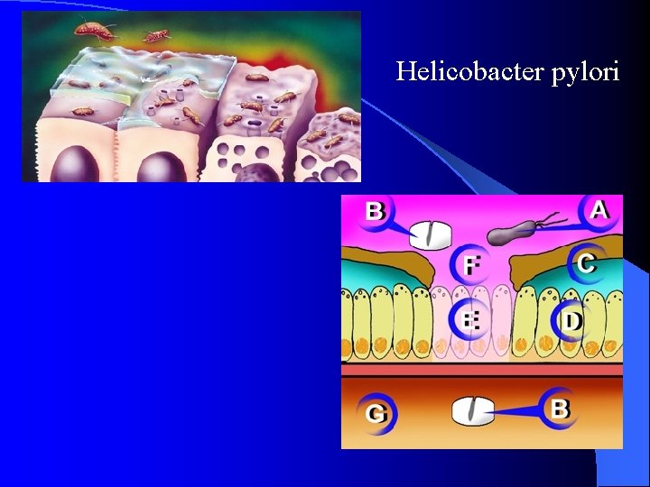 Helicobacter pylori 