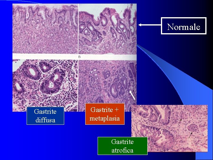 Normale Gastrite diffusa Gastrite + metaplasia Gastrite atrofica 