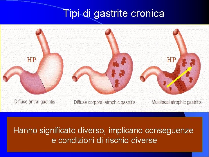 Tipi di gastrite cronica HP HP Hanno significato diverso, implicano conseguenze e condizioni di