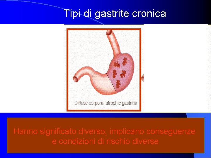 Tipi di gastrite cronica HP HP Hanno significato diverso, implicano conseguenze e condizioni di