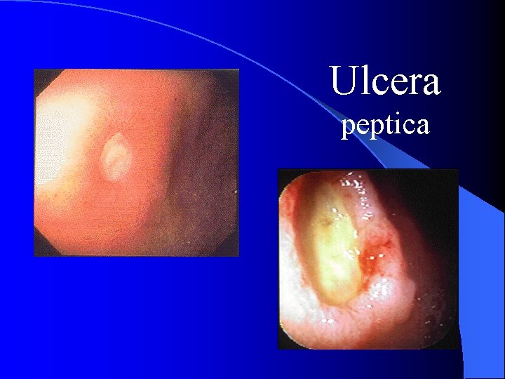 Ulcera peptica 