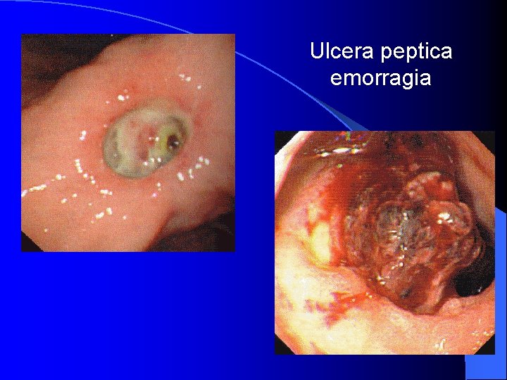 Ulcera peptica emorragia 