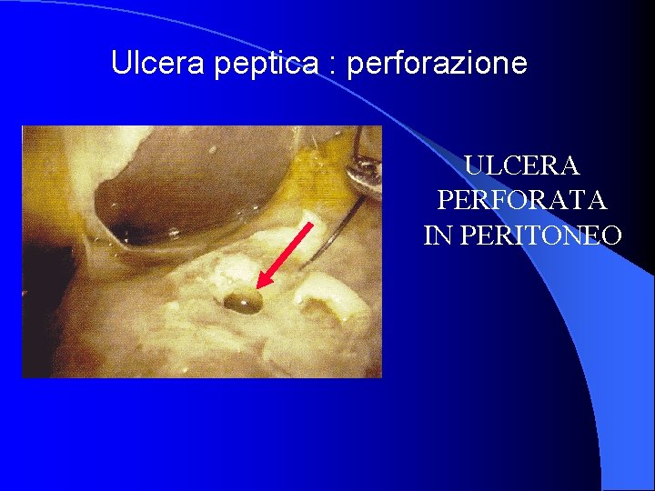 Ulcera peptica : perforazione ULCERA PERFORATA IN PERITONEO 