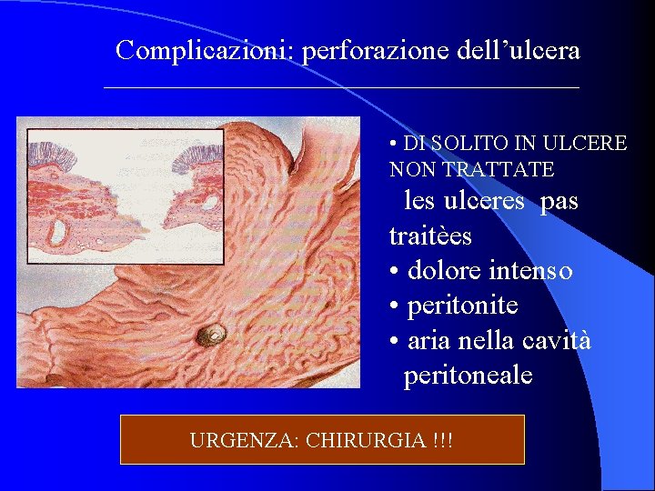 Complicazioni: perforazione dell’ulcera • DI SOLITO IN ULCERE NON TRATTATE les ulceres pas traitèes