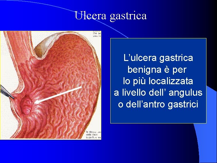 Ulcera gastrica L’ulcera gastrica benigna è per lo più localizzata a livello dell’ angulus