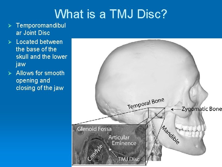 What is a TMJ Disc? Temporomandibul ar Joint Disc Ø Located between the base