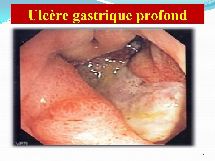 Ulcère gastrique profond 3 