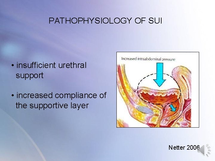 PATHOPHYSIOLOGY OF SUI • insufficient urethral support • increased compliance of the supportive layer PATHOPHYSIOLOGY OF SUI • insufficient urethral support • increased compliance of the supportive layer