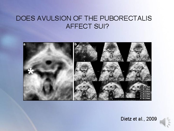 DOES AVULSION OF THE PUBORECTALIS AFFECT SUI? Dietz et al. , 2009 DOES AVULSION OF THE PUBORECTALIS AFFECT SUI? Dietz et al. , 2009