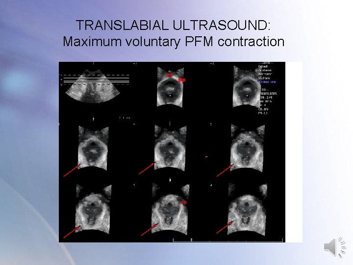 TRANSLABIAL ULTRASOUND: Maximum voluntary PFM contraction TRANSLABIAL ULTRASOUND: Maximum voluntary PFM contraction