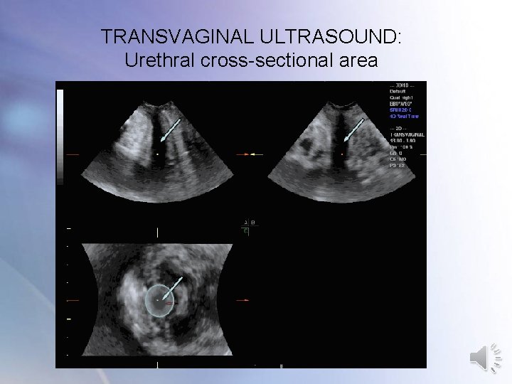 TRANSVAGINAL ULTRASOUND: Urethral cross-sectional area TRANSVAGINAL ULTRASOUND: Urethral cross-sectional area