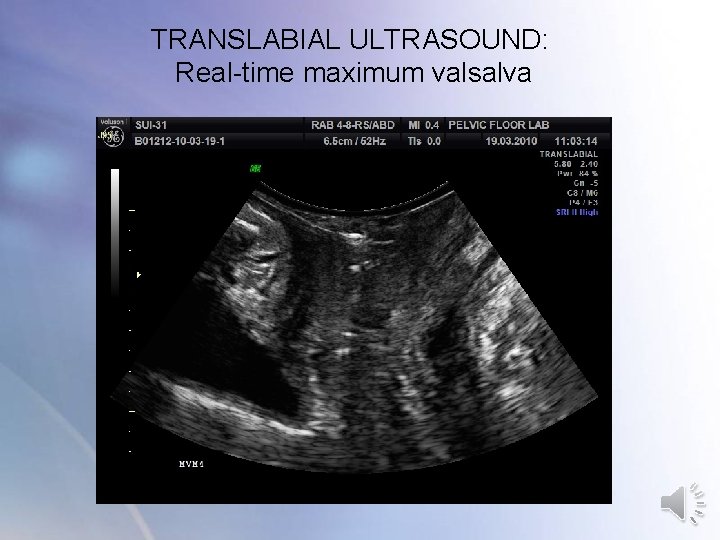 TRANSLABIAL ULTRASOUND: Real-time maximum valsalva TRANSLABIAL ULTRASOUND: Real-time maximum valsalva