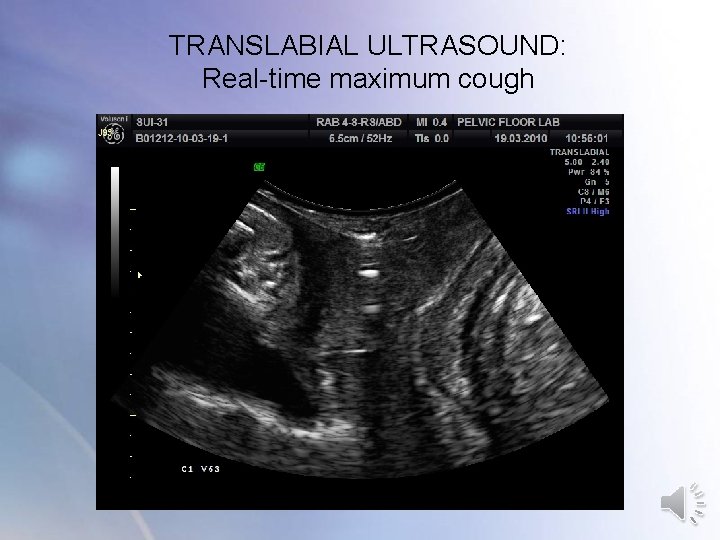 TRANSLABIAL ULTRASOUND: Real-time maximum cough TRANSLABIAL ULTRASOUND: Real-time maximum cough