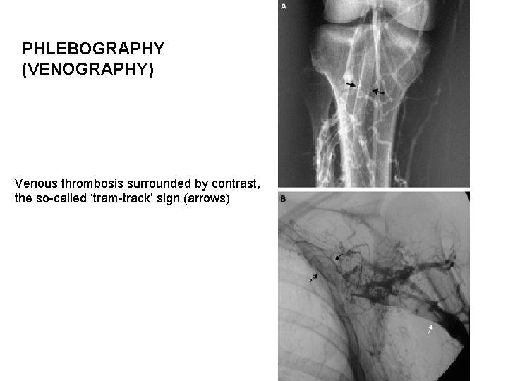 PHLEBOGRAPHY (VENOGRAPHY) Venous thrombosis surrounded by contrast, the so-called ‘tram-track’ sign (arrows) 