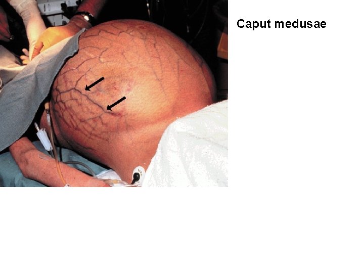 Caput medusae 