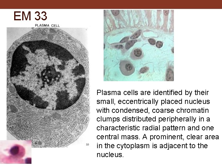 EM 33 Plasma cells are identified by their small, eccentrically placed nucleus with condensed,