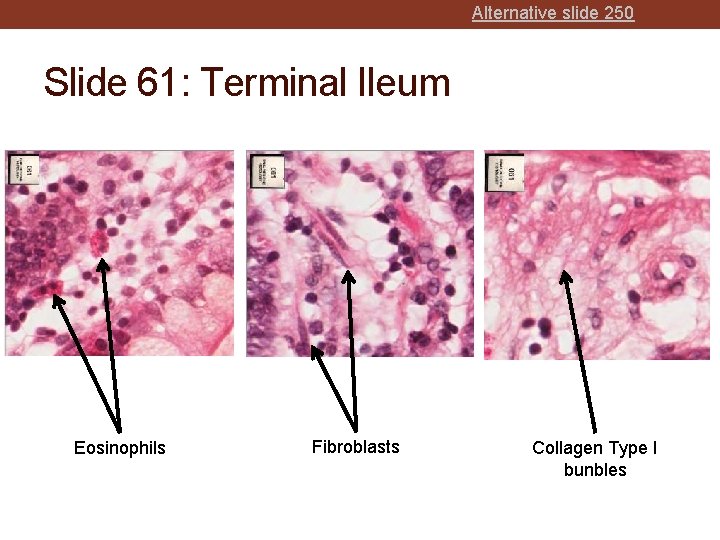 Alternative slide 250 Slide 61: Terminal Ileum Eosinophils Fibroblasts Collagen Type I bunbles 