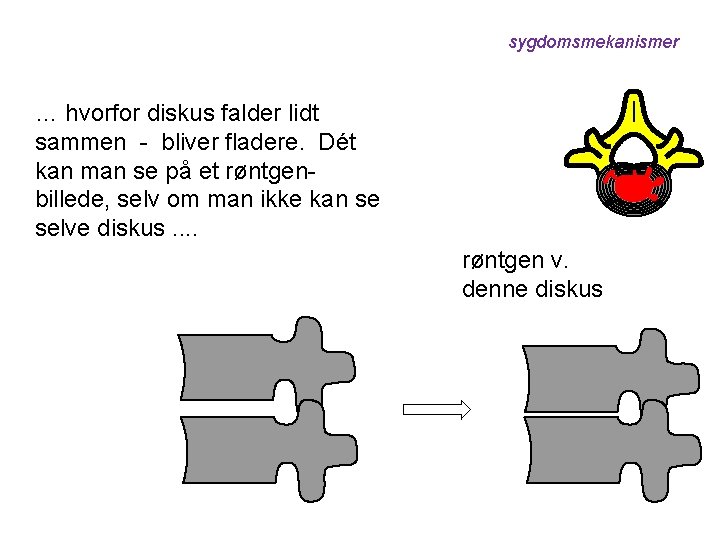 sygdomsmekanismer … hvorfor diskus falder lidt sammen - bliver fladere. Dét kan man se