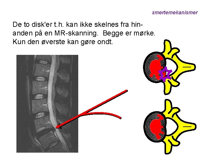 smertemekanismer De to disk'er t. h. kan ikke skelnes fra hinanden på en MR-skanning.
