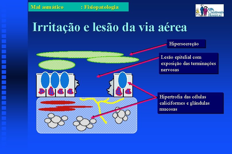 Mal asmático : Fisiopatologia Irritação e lesão da via aérea Hipersecreção Lesão epitelial com