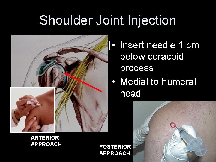 Shoulder Joint Injection • Insert needle 1 cm below coracoid process • Medial to