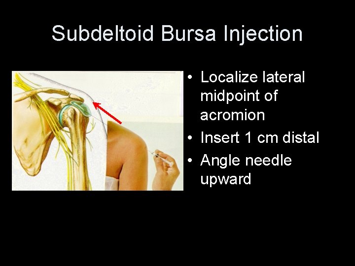 Subdeltoid Bursa Injection • Localize lateral midpoint of acromion • Insert 1 cm distal