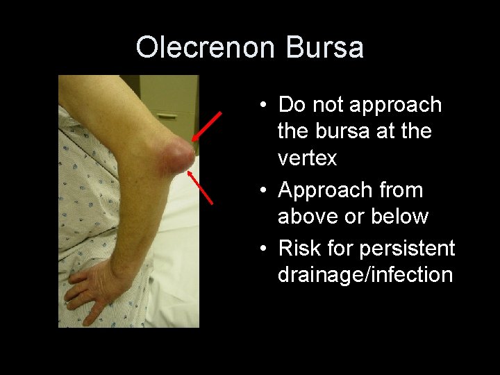Olecrenon Bursa • Do not approach the bursa at the vertex • Approach from
