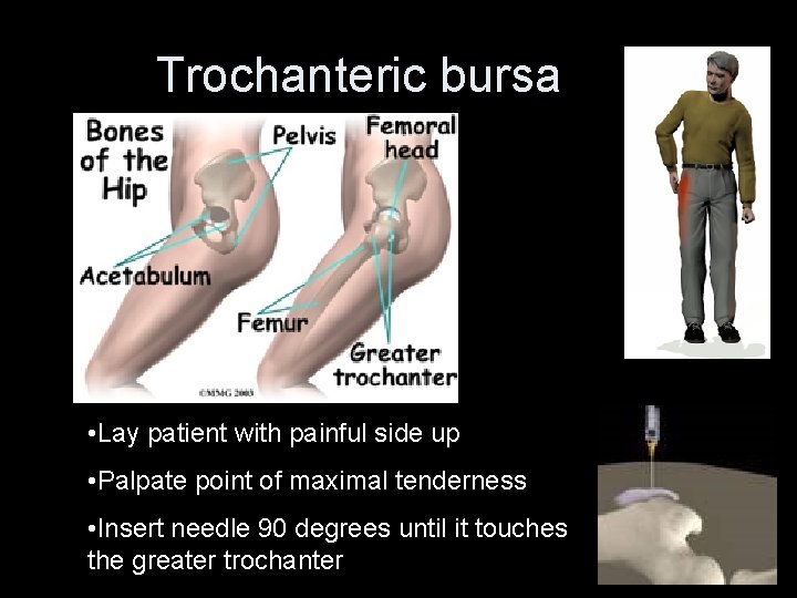 Trochanteric bursa • Lay patient with painful side up • Palpate point of maximal