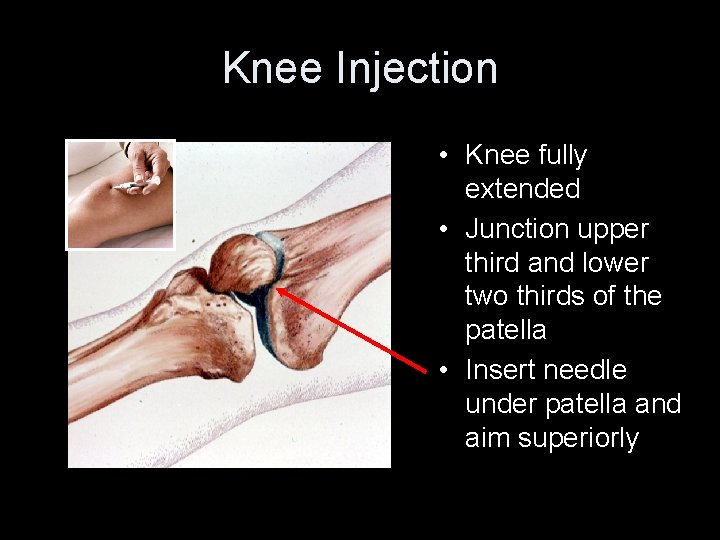 Knee Injection • Knee fully extended • Junction upper third and lower two thirds