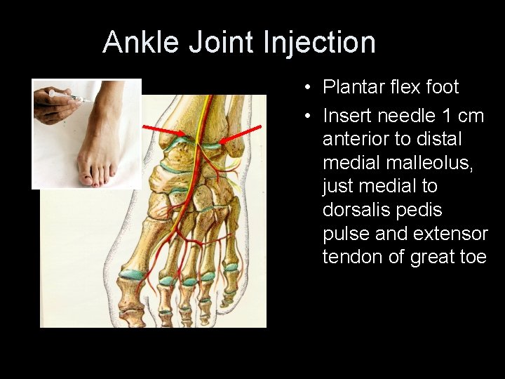 Ankle Joint Injection • Plantar flex foot • Insert needle 1 cm anterior to