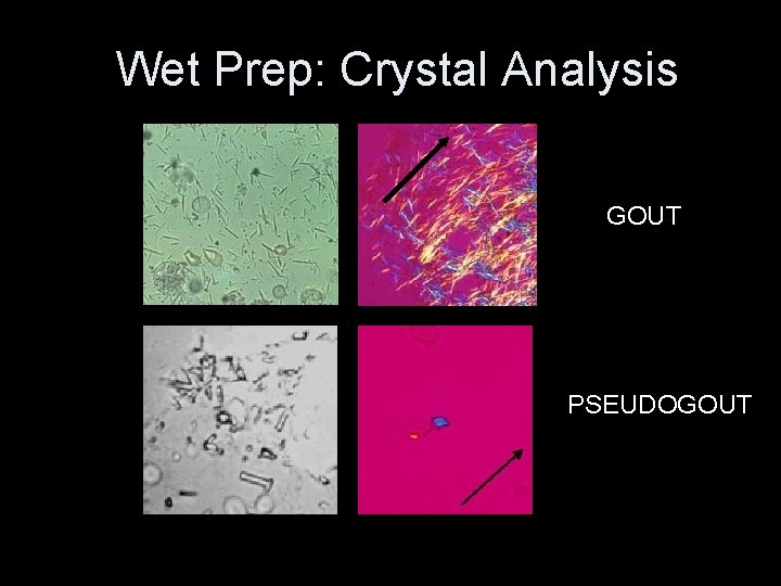 Wet Prep: Crystal Analysis GOUT PSEUDOGOUT 