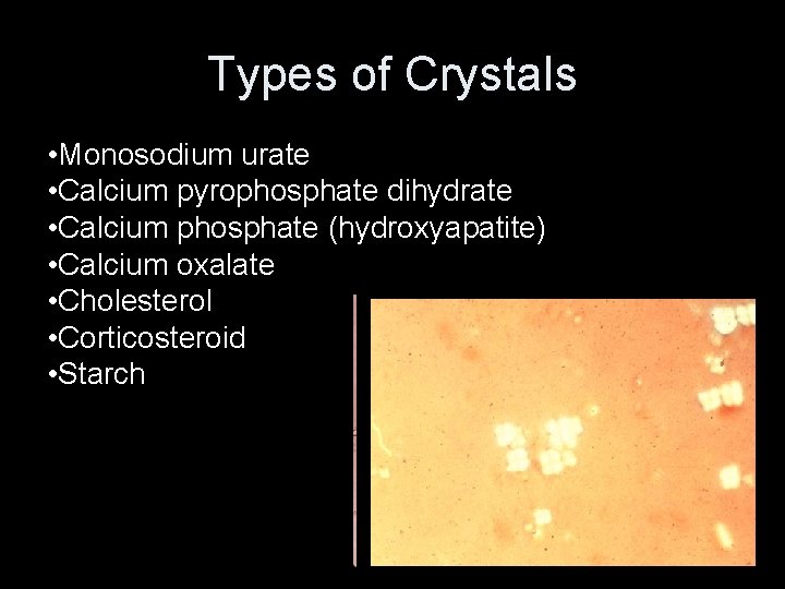 Types of Crystals • Monosodium urate • Calcium pyrophosphate dihydrate • Calcium phosphate (hydroxyapatite)