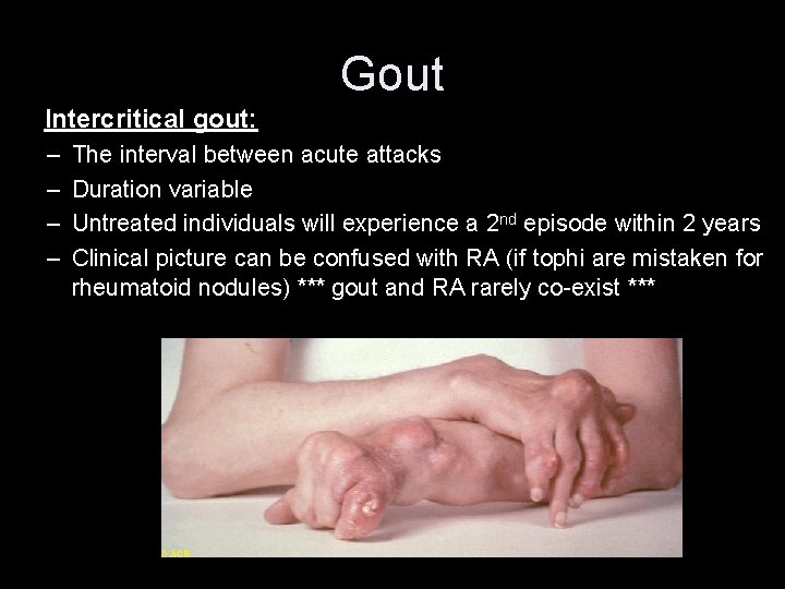 Gout Intercritical gout: – – The interval between acute attacks Duration variable Untreated individuals