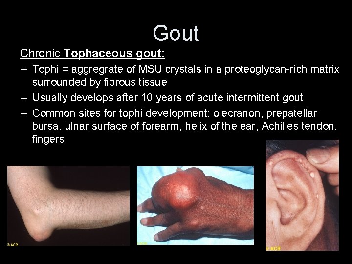 Gout Chronic Tophaceous gout: – Tophi = aggregrate of MSU crystals in a proteoglycan-rich