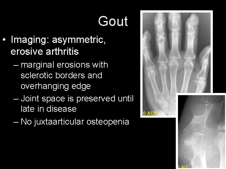 Gout • Imaging: asymmetric, erosive arthritis – marginal erosions with sclerotic borders and overhanging