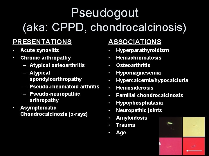 Pseudogout (aka: CPPD, chondrocalcinosis) PRESENTATIONS ASSOCIATIONS • • • • Acute synovitis Chronic arthropathy