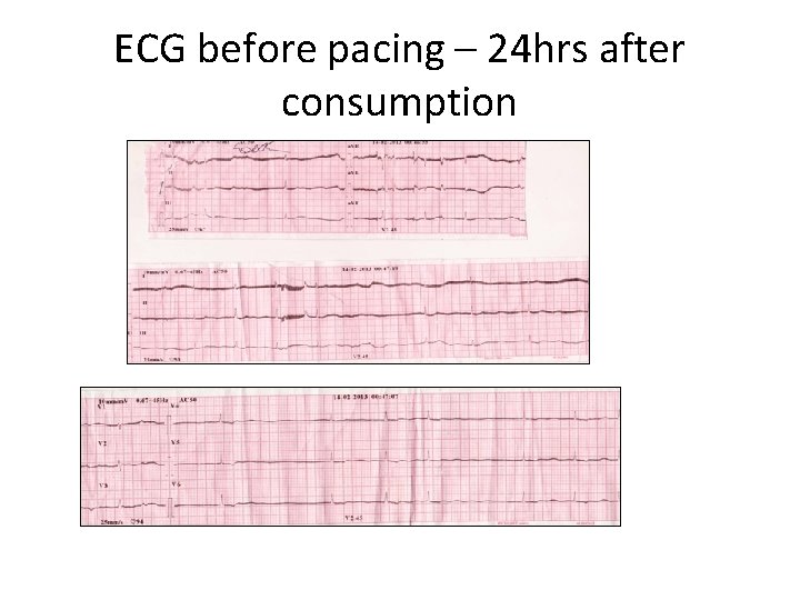 ECG before pacing – 24 hrs after consumption 