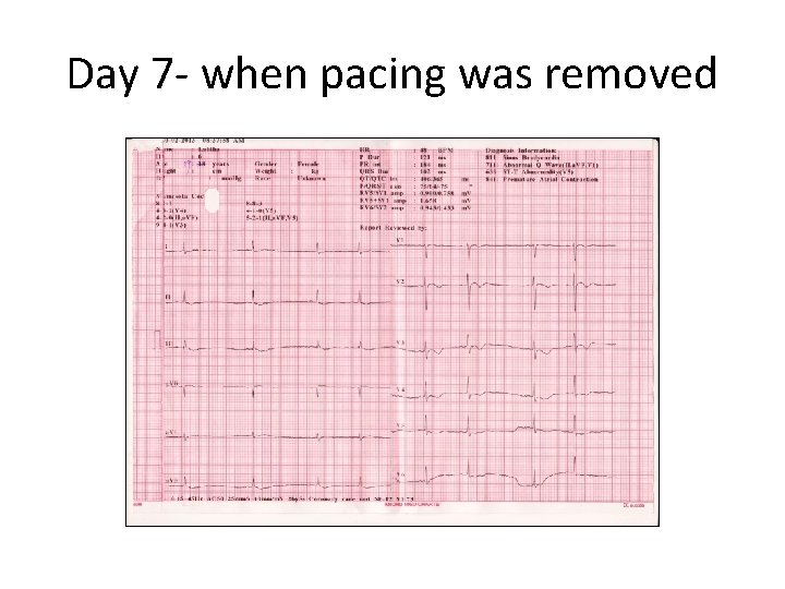 Day 7 - when pacing was removed 