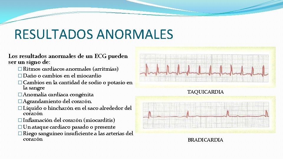 RESULTADOS ANORMALES Los resultados anormales de un ECG pueden ser un signo de: �