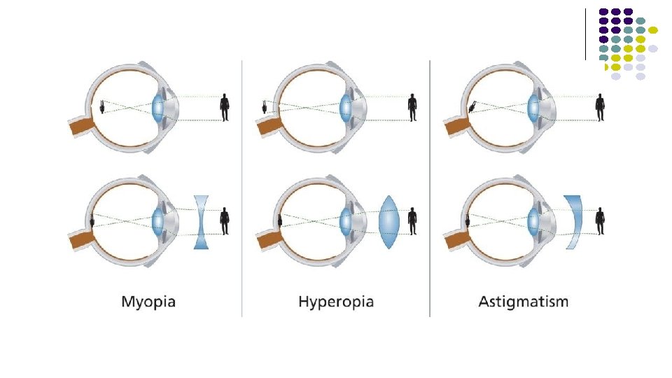astigmatism cu hipermetropie