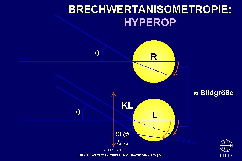 BRECHWERTANISOMETROPIE: HYPEROP R Bildgröße KL L SL@ f. Auge 96114 -39 S. PPT IACLE